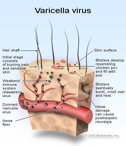varicella_virus.jpg